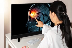 Is a Concussion Considered a Traumatic Brain Injury (TBI)